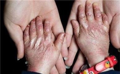 بیماری پروانه‌ای؛ از شکنندگی شدید پوست تا خطر سرطان و مرگ در نوزادان مبتلا